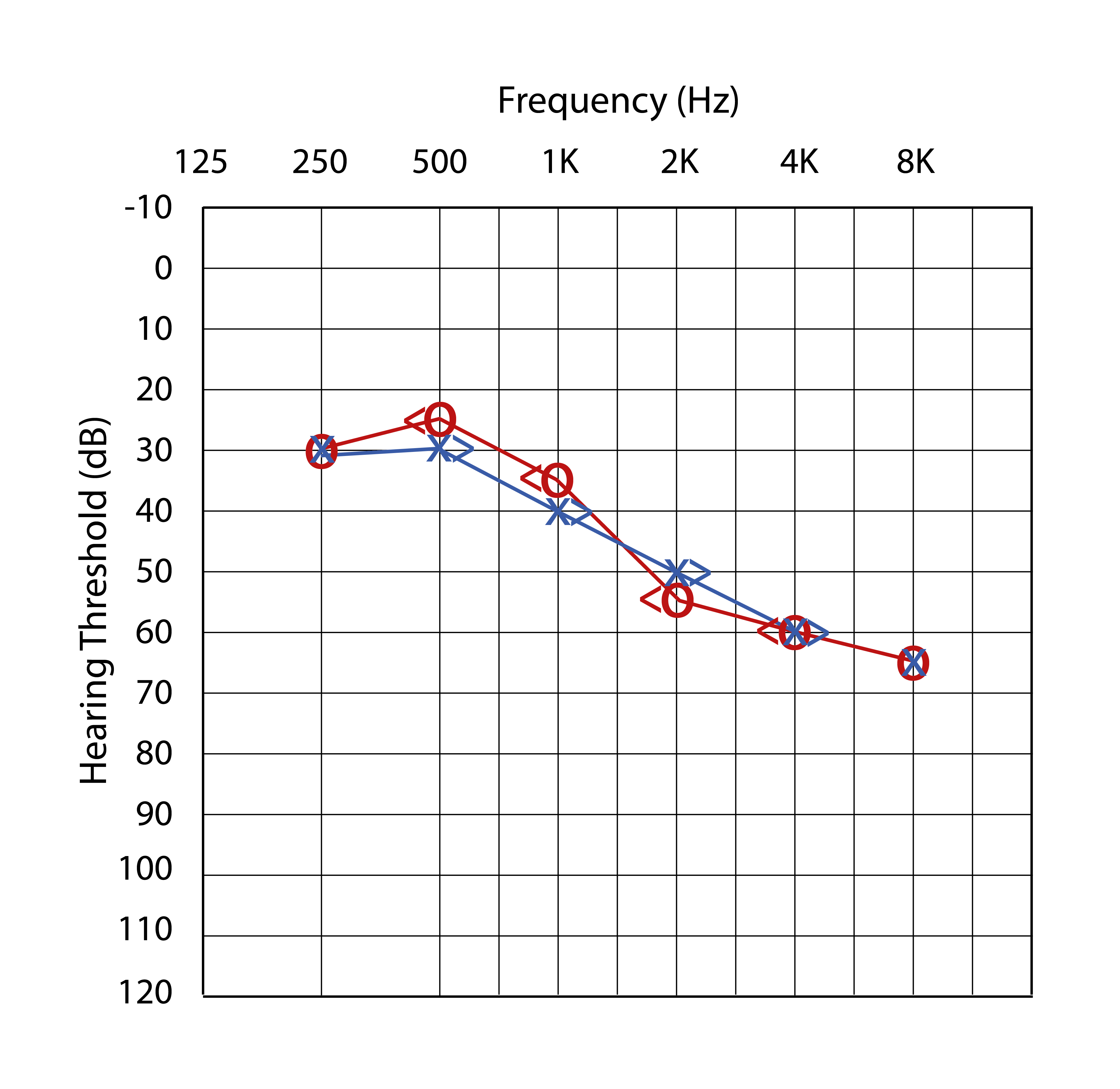 <p>(SNHL) there is a hearing loss in bone conduction as well, bone and air conduction are the same loss</p>