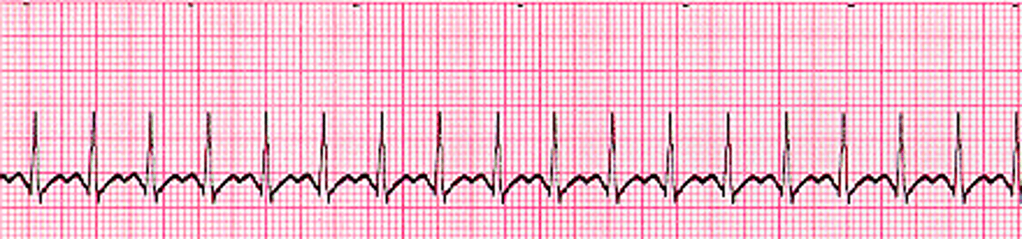 <p>Stable: </p><p>- Vagal maneuvers</p><p>- Chemical Cardioversion: adenosine (may repeat)</p><p>- Amio, cardiology consult</p><p>Unstable: </p><p>- Synchronized Cardioversion</p>