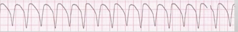 <p>fire continuously due to looping re-entrant pathways in ventricles (most common)</p><ul><li><p>can create or not create pulse at times</p></li><li><p>Faster rate,&nbsp;no P waves &amp; PR, wide (>0.12) QRS</p></li><li><p>Regular</p></li></ul><p></p>
