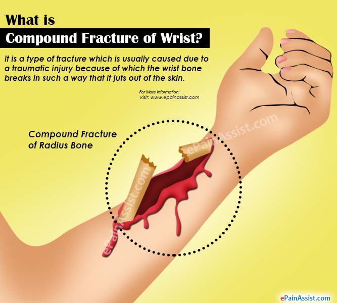 bone breaks through the skin