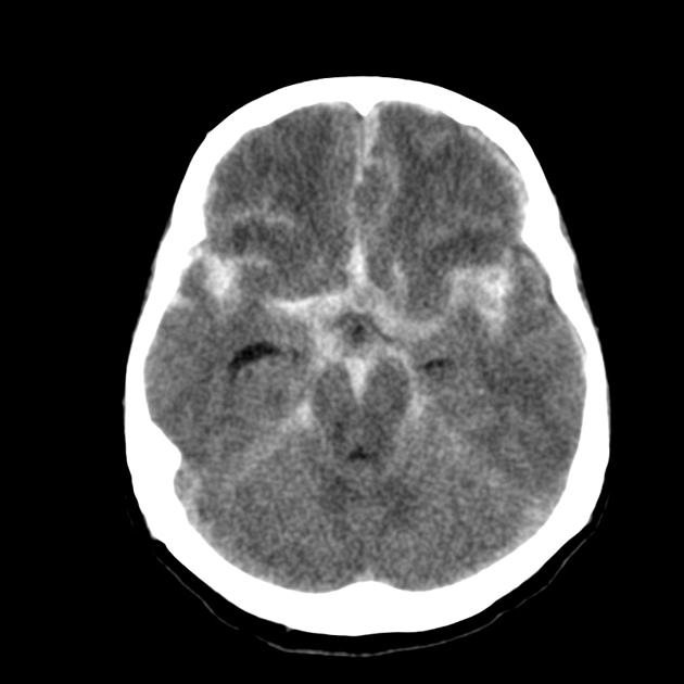 <p>Subarachnoid Haemorrhage - blood collects beneath the arachnoid mater in the subarachnoid space (occurs near site of a skull #) </p>
