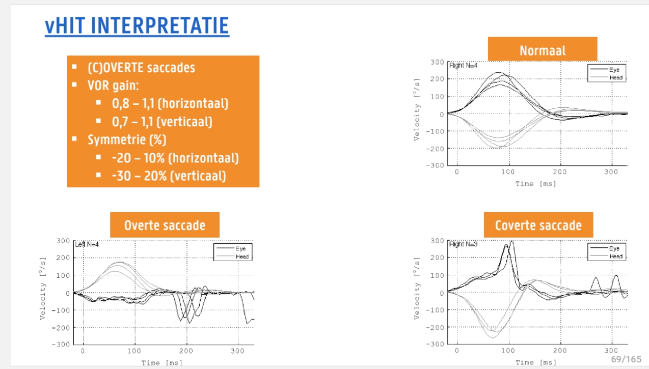 <p>(C)OVERTE saccades<br><span data-name="black_small_square" data-type="emoji">▪</span> VOR gain:</p><ul><li><p>0,8 – 1,1 (horizontaal)</p></li><li><p>0,7 – 1,1 (verticaal)</p></li></ul><p>Symmetrie (%)</p><ul><li><p>-20 – 10% (horizontaal)</p></li><li><p>-30 – 20% (verticaal)</p></li></ul><p>normaal= hoofd 1 richting, ogen exact tegengesteld</p><p>Overte = hoofd draait, ogen bewegen mee (vlake lijn)+ daarna correctie saccade waneer hoofdbeweging stopt (dip) → kan je zien zonder apparatuur&nbsp;</p><p>Coverte = hoofd draait, ogen bewegen effkes mee en dan tijdens hoofdbewging saccade (niet zictbaar met blote oog)</p>