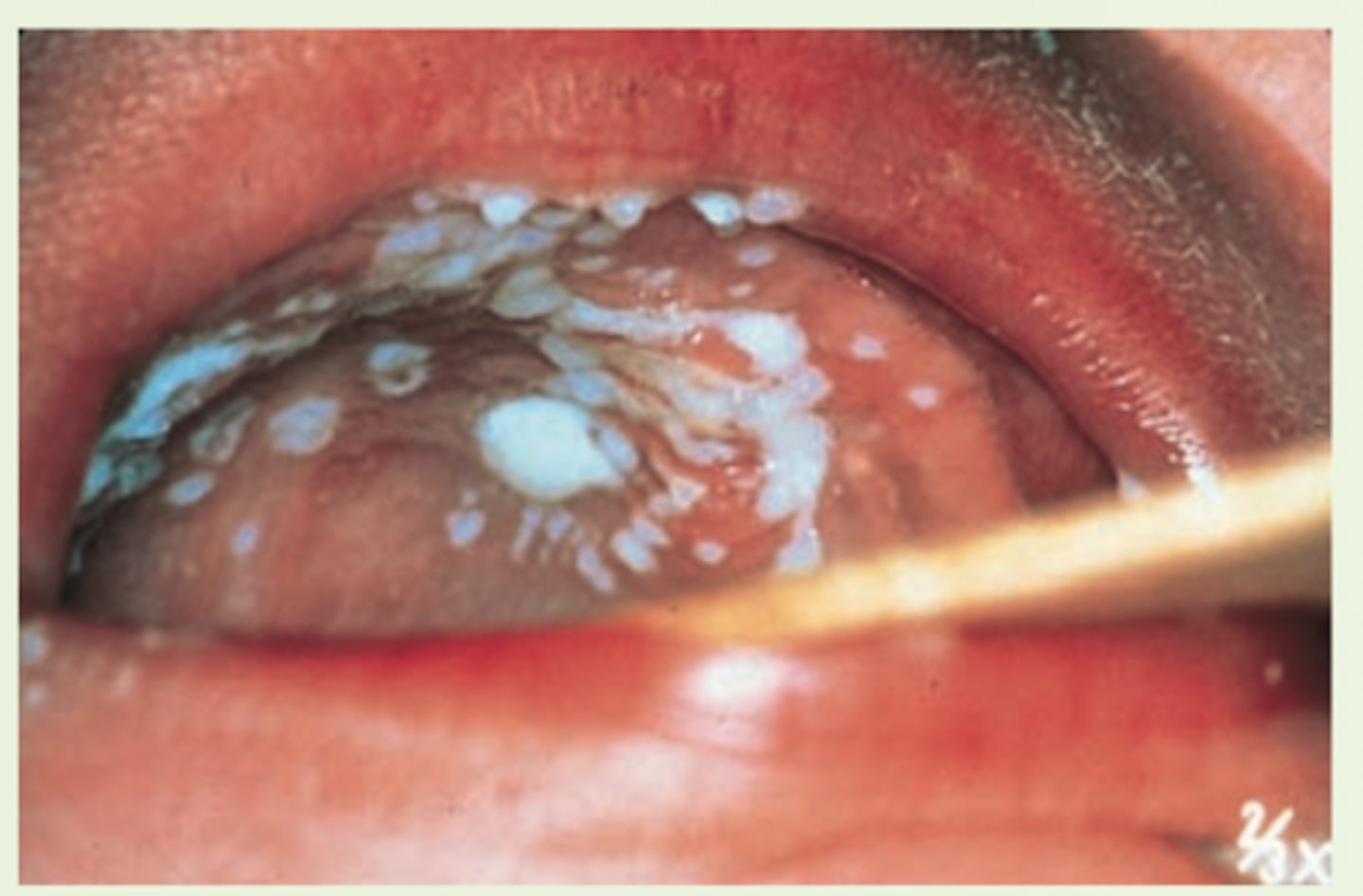 <p>candida albicans; tx is w/ nystatin mouthwash, clotrimazole troaches or oral fluconazole</p>