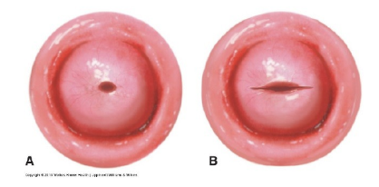 <ul><li><p>bruised</p></li><li><p>edematous</p></li><li><p>cervical os remains changed</p></li><li><p>back to normal in 6 weeks</p></li></ul>