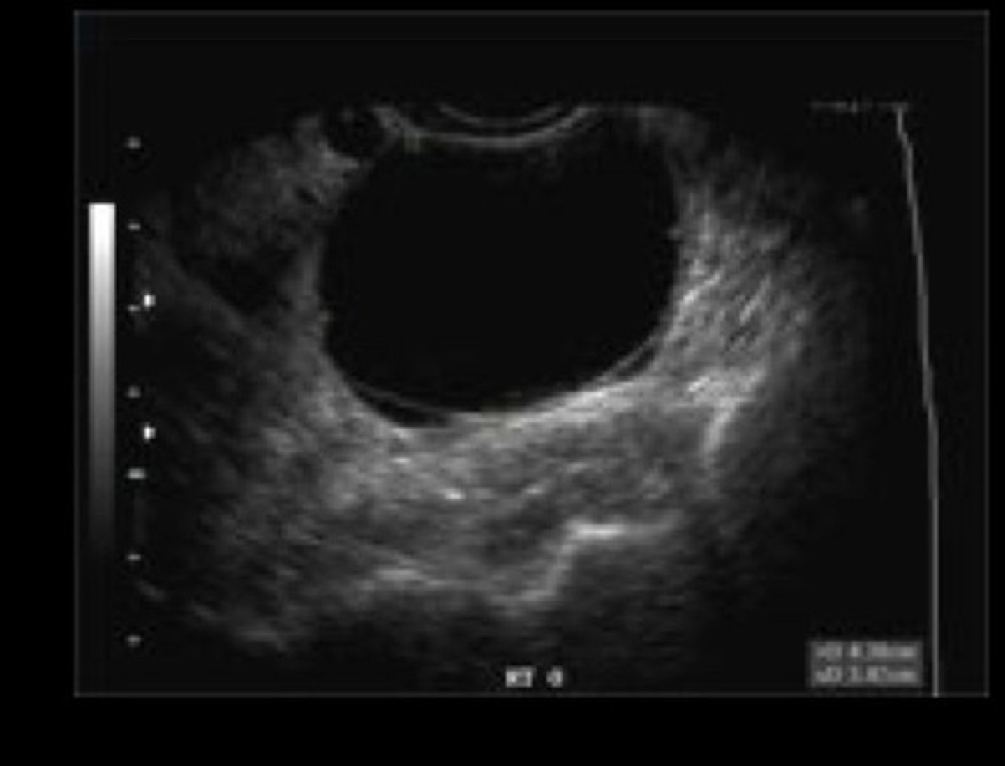 <p>Define Condition:</p><p>-Hx: YOUNGER Age</p><p>-Path: Benign if simple (if complex - aka w/ solid components OR persists --&gt; WORRISOME)</p><p>-Dx:</p><p>&gt; US!</p><p>&gt; FNA for Sx relief and/or diagnosis</p>