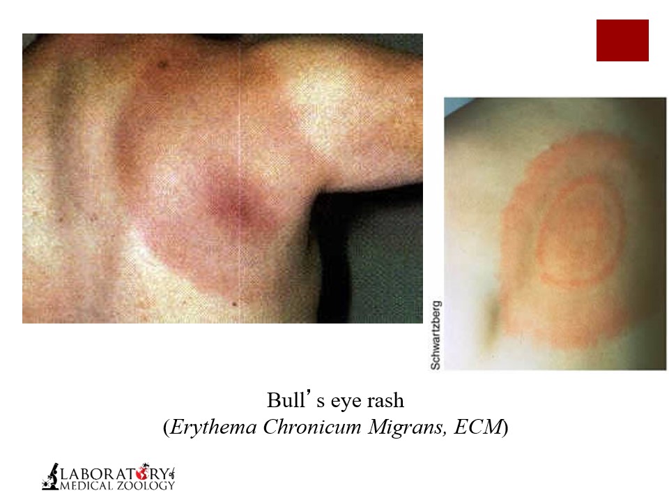 <p>c) Erythema migrans (bull’s eye rash)</p>
