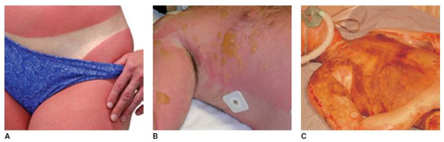 involve the epidermis and some portion of the dermis but not subcutaneous tissue, blisters and skin that is white to red, moist, and mottled 