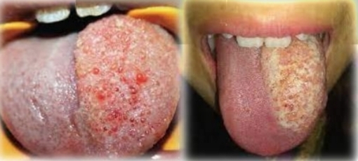 <p>Localised/diffuse, translucent/red/purple swelling with smooth/pebbly surface. Soft and compressible.</p><p class="has-focus">Crepitus may be palpated</p><p class="has-focus">Infancy, detectable by 2 years</p><p class="has-focus"><strong>Found on:</strong></p><p class="has-focus">Oral sites - tongue, lip, buccal mucosa</p><p class="has-focus">Up to 75% on head and neck</p>