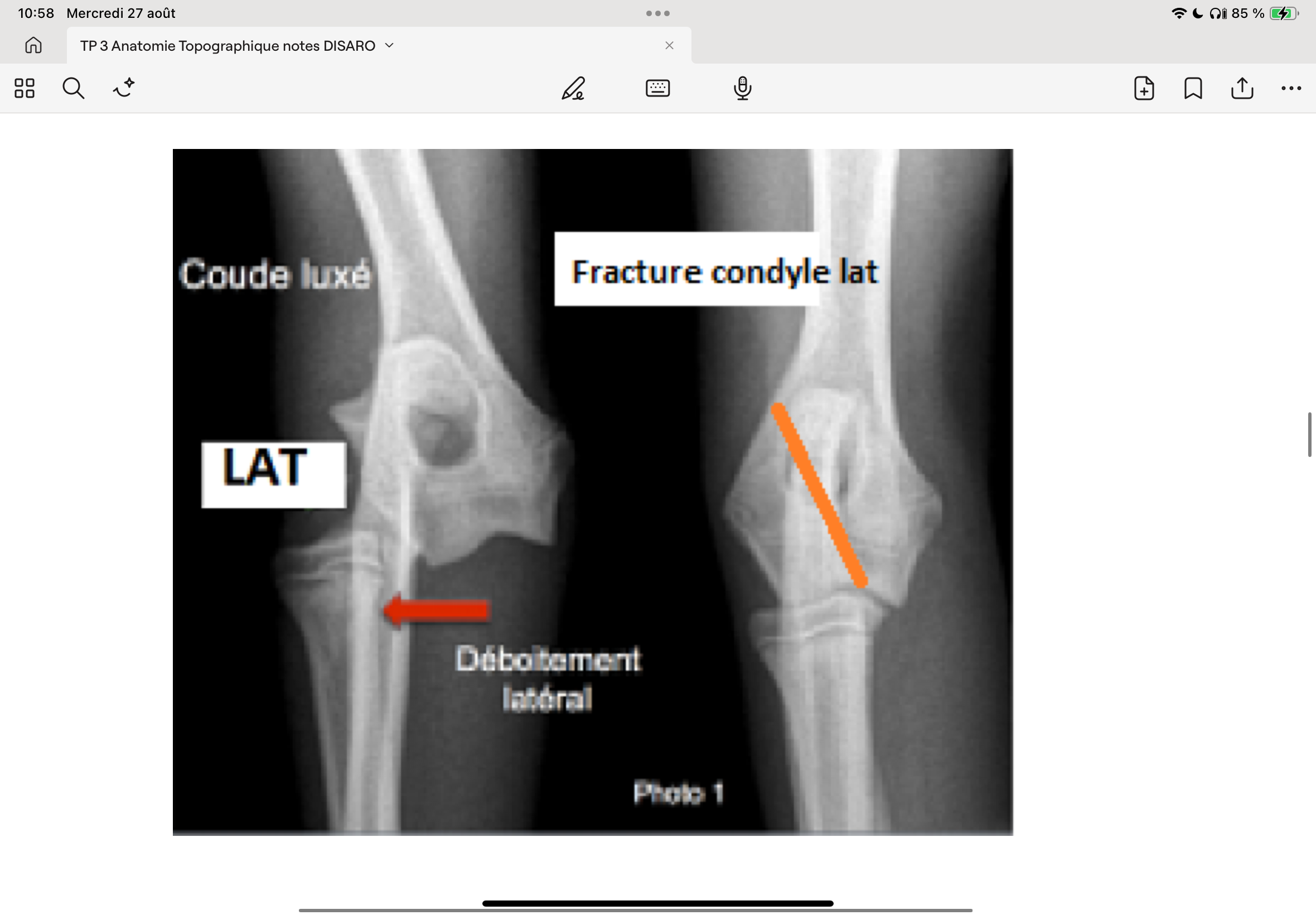 <p>Moyens d’unions: ligaments collatéraux + ligament annulaire (solidarise radius-ulna) + ligament oblique</p>
