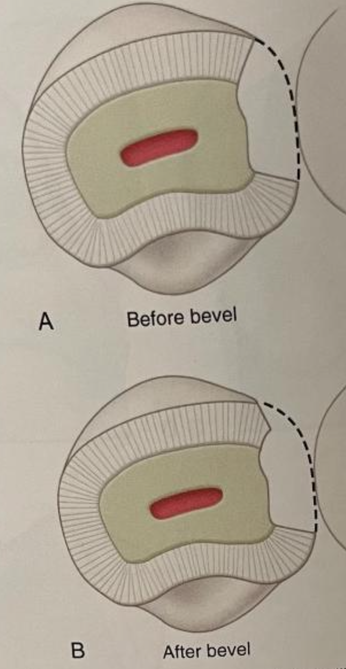 <p>cut an angle that is not a right angle, having a slant</p><ul><li><p>bevel facial aspect of prep if decay is on facial or extends facially enough that it can be seen from the facial</p></li><li><p>increases surface area for bonding at margin, increasing marginal seal</p></li><li><p>improves esthetics by gradually transitioning from tooth to restoration</p></li></ul><p></p>