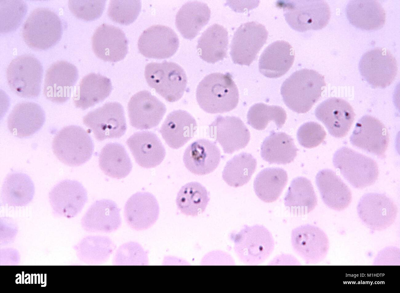 <p><strong>Lab differentiation:</strong></p><ul><li><p><strong>Microscopy:</strong> Seen in <strong>thin and thick blood smears</strong> stained with Giemsa. Rings, trophozoites, schizonts, and sometimes crescent-shaped gametocytes are visible inside red blood cells. Parasitemia can be high.</p></li><li><p><strong>Rapid diagnostic tests (RDTs):</strong> Detect antigens such as HRP2 or pLDH.</p></li><li><p><strong>Culture:</strong> Not routinely cultured in standard labs; maintained in specialized in vitro cultures for research.</p></li></ul><p><span data-name="woman_health_worker" data-type="emoji">š©āā</span> <strong>Patient scenario:</strong><br>A 25-year-old traveler returns from sub-Saharan Africa with high fever, chills, and sweating every 48 hours, along with fatigue and headache. Blood smear shows numerous ring-shaped parasites inside red blood cells, some with crescent-shaped gametocytes. Diagnosis: severe <strong>falciparum malaria</strong>.</p><p><span data-name="clipboard" data-type="emoji">š</span> <strong>Details:</strong><br><strong>(A) Classification:</strong> Protozoan parasite, apicomplexan, infects human red blood cells.<br><strong>(B) Disease:</strong> Causes <strong>malaria</strong>, which may present as cyclical fever, anemia, splenomegaly, and in severe cases, cerebral malaria or multi-organ failure.<br><strong>(C) Identification/Diagnosis:</strong> Thick and thin blood smears with Giemsa stain; RDTs for rapid antigen detection; PCR for confirmation in specialized labs.<br><strong>(D) Treatment/Prevention:</strong> Artemisinin-based combination therapy (ACT) is first-line. Prevention includes mosquito control, insecticide-treated bed nets, prophylactic antimalarials, and vaccines (RTS,S in endemic regions).<br><strong>(E) Unique Epidemiology & Lab Safety:</strong> Transmitted by <strong>Anopheles mosquitoes</strong>; humans are primary host. Parasite exhibits antigenic variation to evade immunity. Laboratory work should follow <strong>BSL-2</strong> procedures, using standard precautions to avoid handling infected blood.</p>