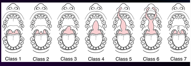 <p><span><strong>• Based on disturbances in the embryologic formation of the lip and palate as they develop from the premaxillary region toward the uvula in a definite pattern </strong></span></p><p><span><strong>• Described based on structures involved, unilateral or bilateral, severity </strong></span></p><p><span><strong>• No universally agreed upon classification </strong></span></p><p><span><strong>1. Class 1: cleft of the tip of the uvula </strong></span></p><p><span><strong>2. Class 2: cleft of the uvula (bifiduvula) </strong></span></p><p><span><strong>3. Class 3: cleft of the soft palate </strong></span></p><p><span><strong>4. Class 4: cleft of the soft and hard palates </strong></span></p><p><span><strong>5. Class 5: cleft of the soft and hard palates that continues through the alveolar ridge on one side of the premaxilla, usually associated with cleft lip of the same side </strong></span></p><p><span><strong>6. Class 6: cleft of the soft and hard palates that continues through the alveolar ridge on both sides, leaving a free premaxilla, usually associated with bilateral cleft lip </strong></span></p><p><span><strong>7. Class 7: submucous cleft in which the muscle union is imperfect across the soft palate. The palate is short, the uvula is often bifid, a groove is situated at the midline of the soft palate, and the closure to the pharynx is incompetent. </strong></span></p>