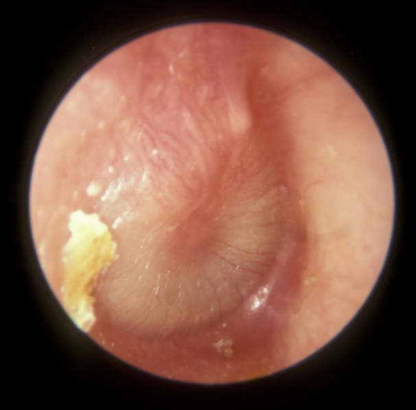 <p>Infection of the middle ear</p>