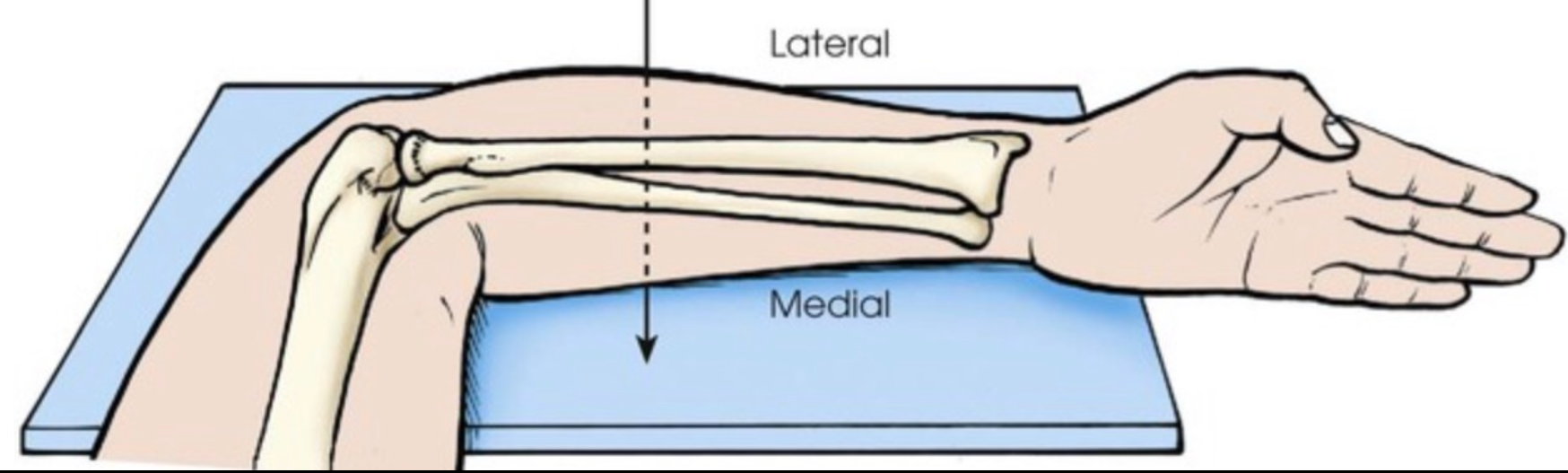 <p>Better example of Lateral and Medial . It’s based off of anatomic position </p>