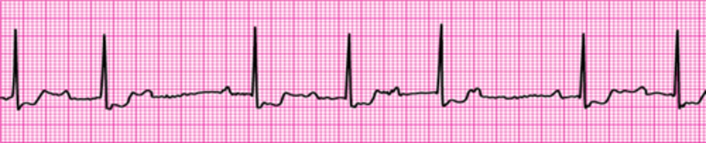 <p>Second-degree atrioventricular block (Mobitz I Wenckebach)</p>