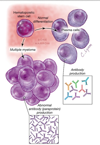 multiple myeloma
-Bence Jones protein is light chain Ig - causes renal toxicity and obstruction
-*hypercalcemia* is also found