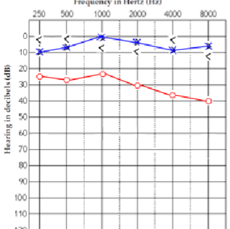<p>what paitient is is? What kind of hearing loss do they have? </p>