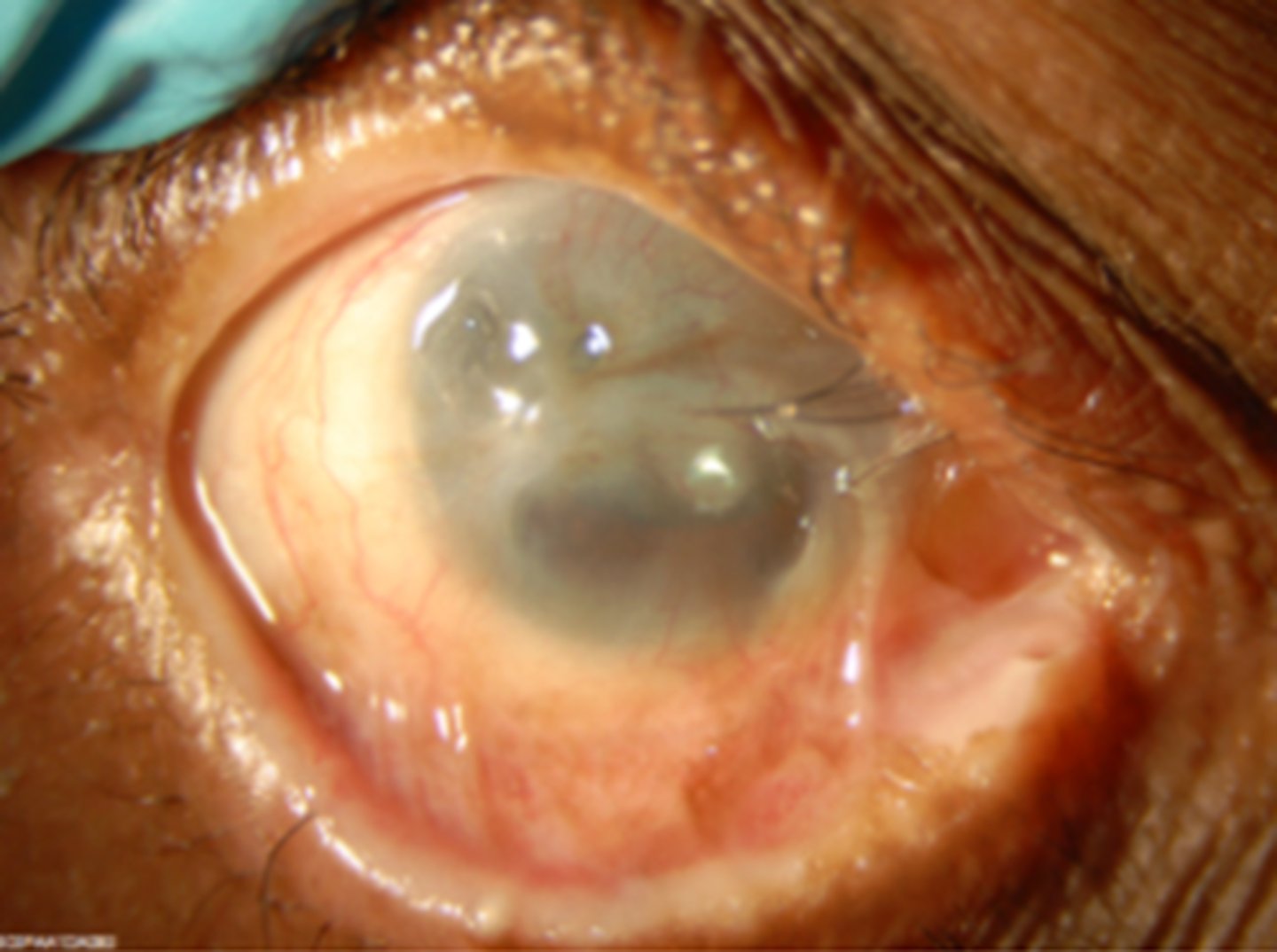 <p>What do we want to consider with eyelid health during pre-op evaluation?</p>
