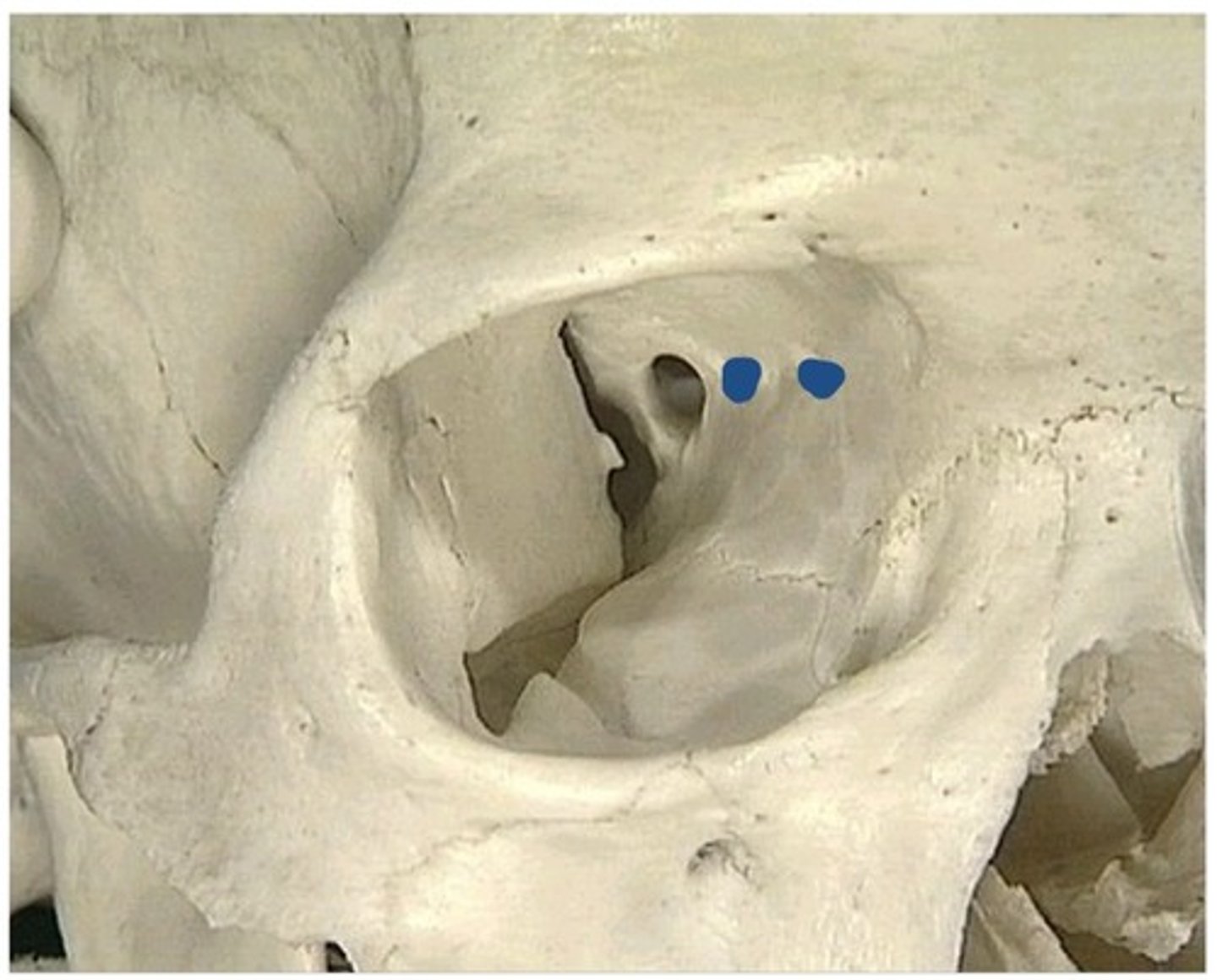 <p>1. Anterior ethmoidal foramen</p><p>2. Posterior ethmoidal foramen</p>