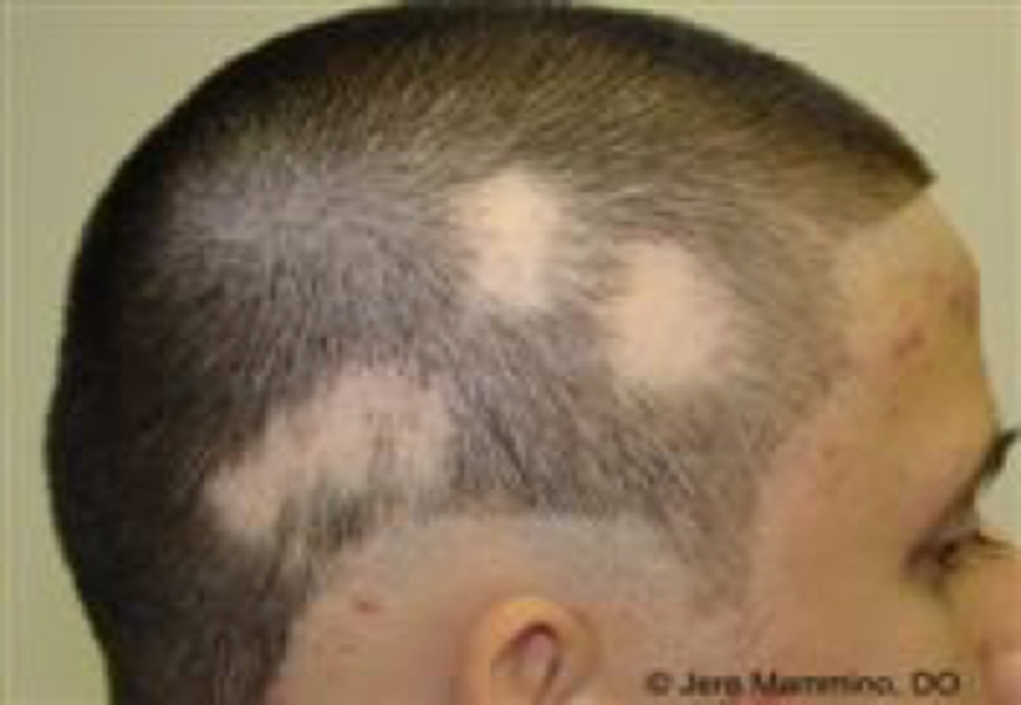 <p>loss of hair</p>