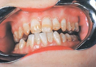 <ul><li><p>may occur alongside enamel hypoplasia or hypocalcification</p></li></ul><ul><li><p>hypomineralization occurs due to excessive systemic fluoride level that causes white spots or brown putting</p></li><li><p>may occur due to oxidative stress to the ameloblast from excess fluroide</p></li></ul><p></p>