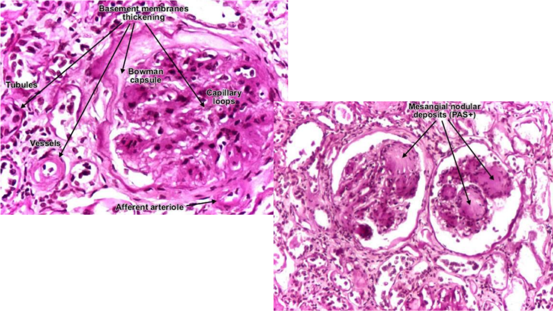 <p>Diabetic Glomerulosclerosis</p>