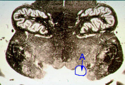 <p>Identify the structure indicated by the outline and letter "A".</p><p><span>A. Hypoglossal nucleus</span></p><p><span>B. Dorsal motor nucleus of the vagus</span></p><p><span>C. Nucleus ambiguous</span></p><p><span>D. Abducens nucleus</span></p><p><span>E. Inferior cerebellar peduncle</span></p><p></p>