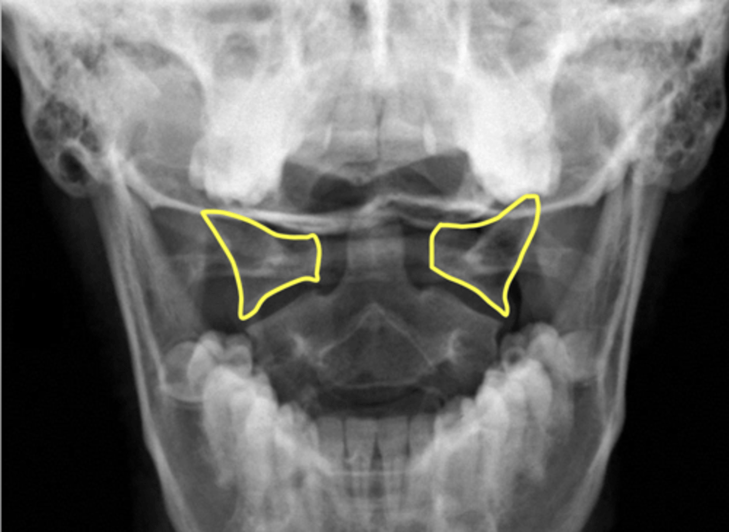 <p>What are outlined in yellow?</p>