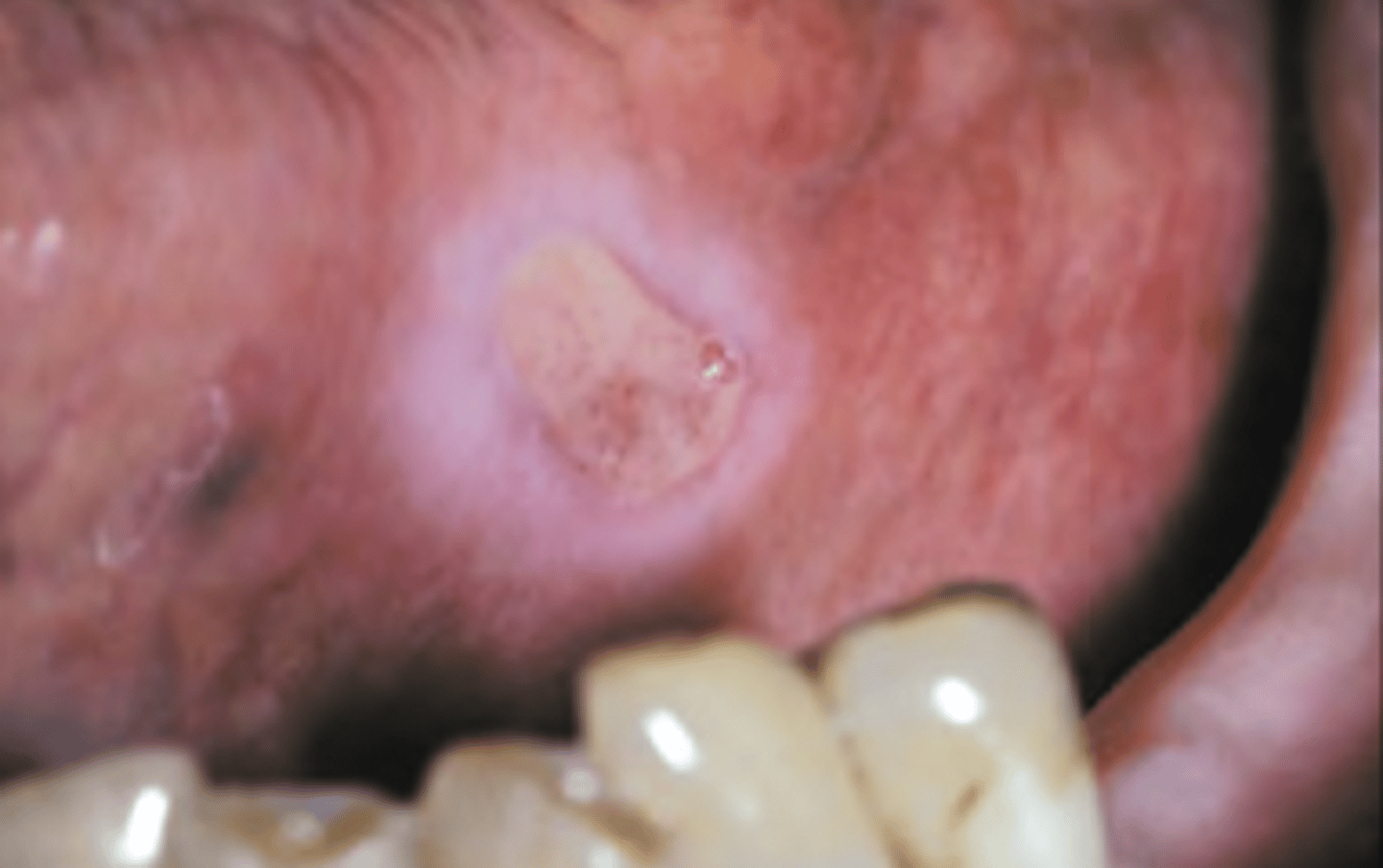 <p>associated with trauma</p><p>• common locations: cheek, lips, tongue</p><p>• heals within 14-21 days</p>