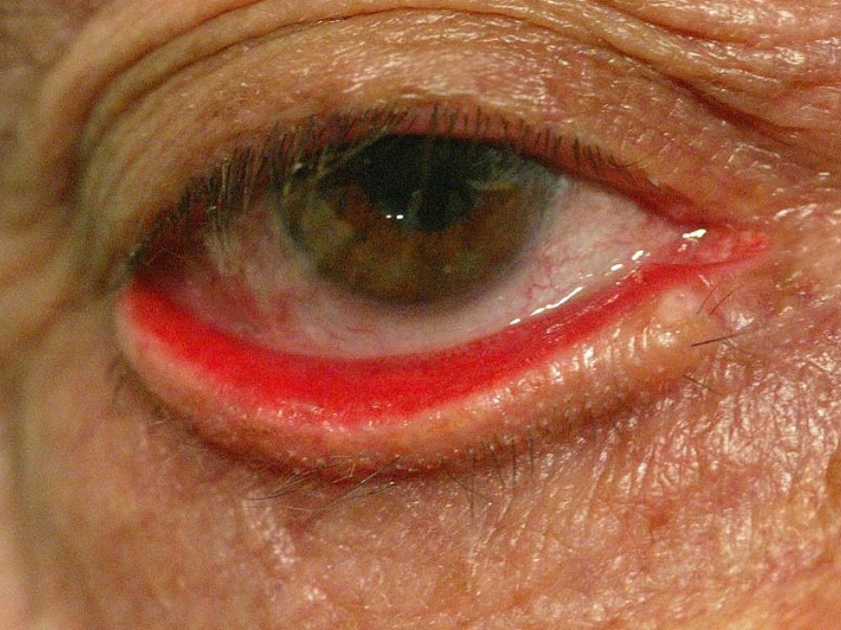 <p>Name this condition</p>