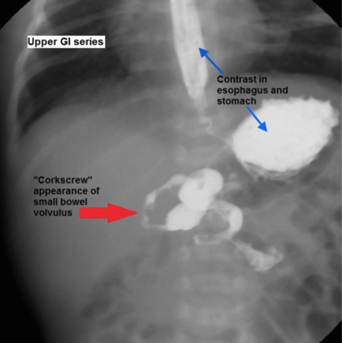 <p>Initial: abdominal x-ray - double bubble sign and/or air-fluid levels (remember need to d/dx duodenal atresia from this)</p><p>Best: upper GI contrast series/contrast enema - twists of barium w/ bowel pushed over to the right</p>