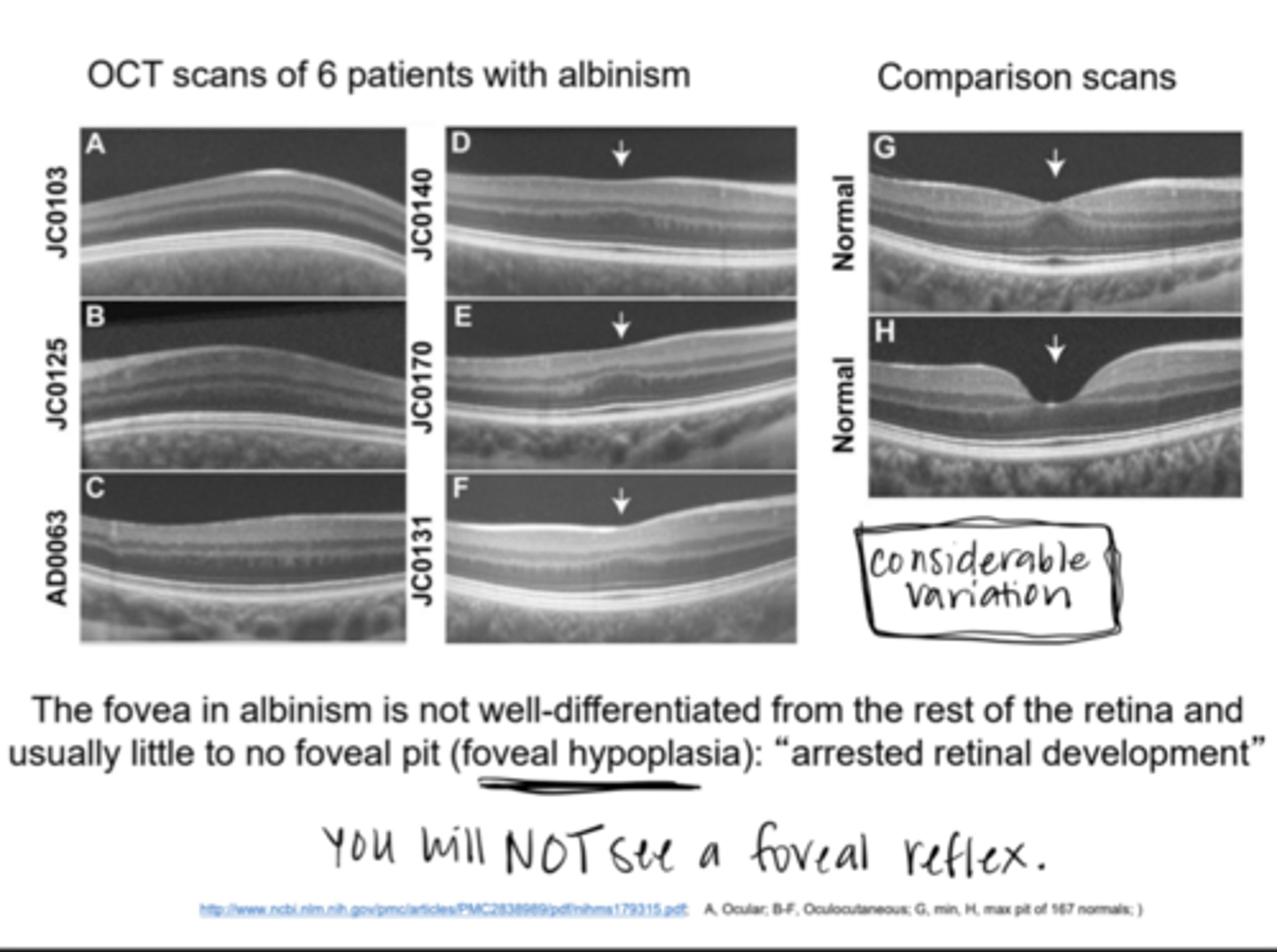 <p>Does the fovea in an individual with albinism show a foveal pit?</p>