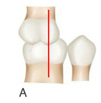 <p>angle class __ molar relationship</p>