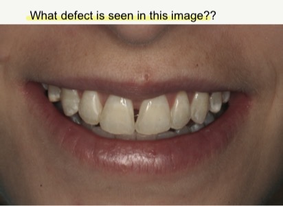 <p>What defect is seen in this image?</p>