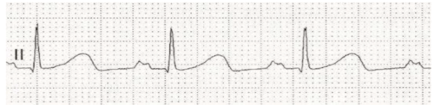 <p>this is a dog's ECG. by looking at the P wave, what do we think is wrong with this heart?</p>