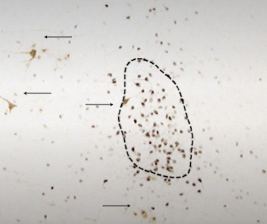 <p>Ventrolateral nucleus of ventromedial hypothalamus (VL-VMH) controls PAG which controls medullary reticular formation (MRF) which is responsible for lordosis posture in female rats.</p><p>We found that there’s some overlap of ER and controlling neurons, but mostly they are separate. So neurons with estrogen receptors probably talk to neurons that then control PAG =&gt; MRF =&gt; back muscles.</p>