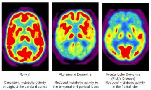 <p><strong>Positron Emission Tomography</strong></p><p><strong>Measures regional glucose consumption; </strong>Subject is injected with a small amount of radioactive glucose, and this scan the absorption of radioactivity outside the head</p><ul><li><p>If brain cells are more active, they will consume more radioactive glucose, and vice versa</p></li><li><p>More commonly used before the fMRI</p></li><li><p>Shows the FUNCTION of the brain</p></li></ul><p></p>