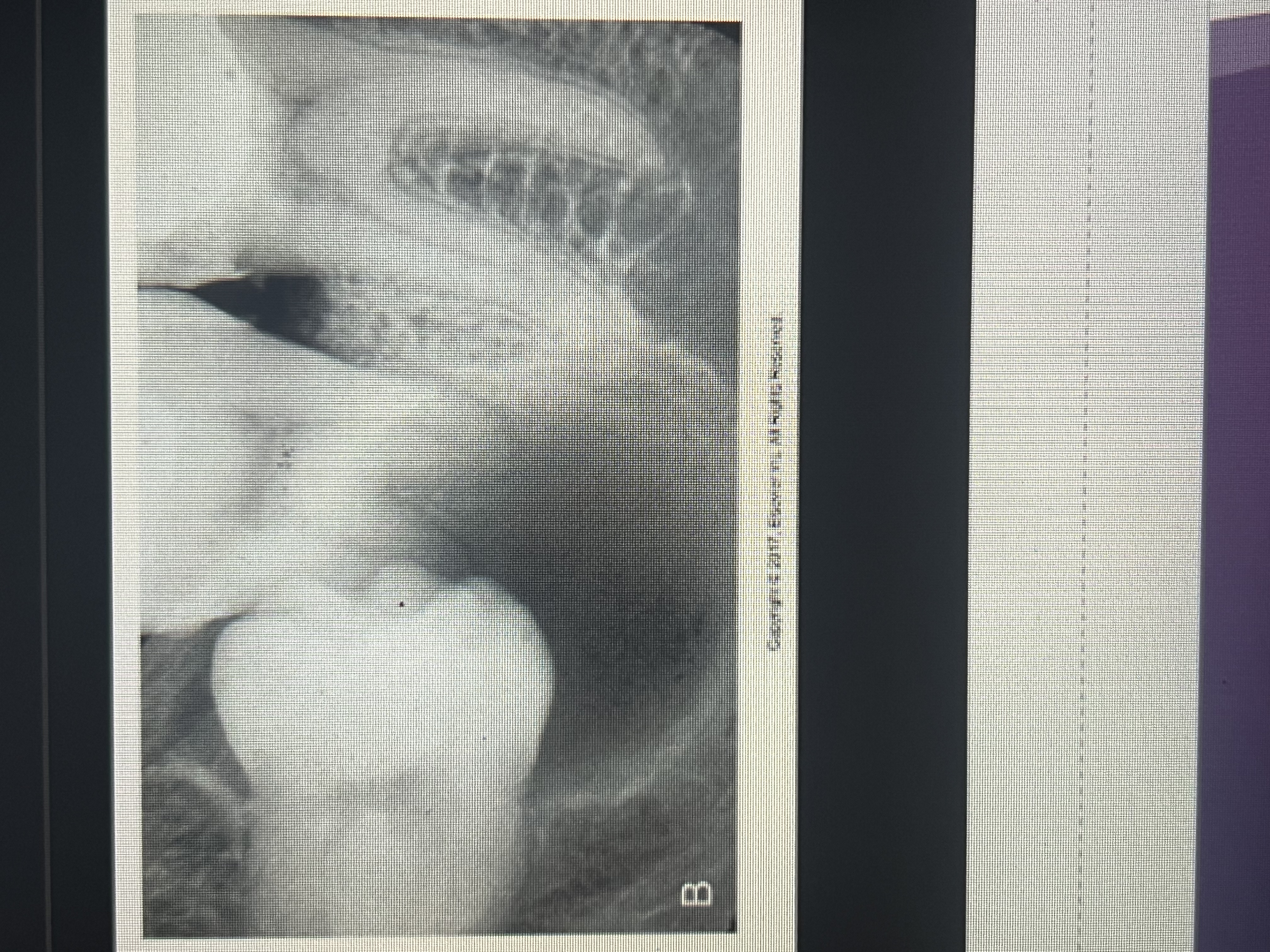 <p>A lesion located between the roots of adjacent teeth.</p>