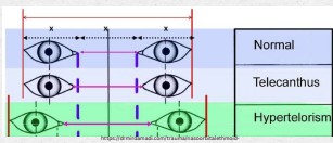 <ul><li><p><span>Similar to hypertelorism but specifically refers to the distance between the inner canthi.</span></p></li><li><p><span>Common in syndromes like Down Syndrome, Klinefelter Syndrome, and Turner Syndrome.</span></p></li><li><p><span>What to do: Recognize that patient may have other co-morbidities (developmental delays, syndromic features, ophthalmic manifestations)</span></p></li><li><p><span>Treatment: Monitoring or surgical intervention in extreme cases.</span></p></li></ul><p></p>