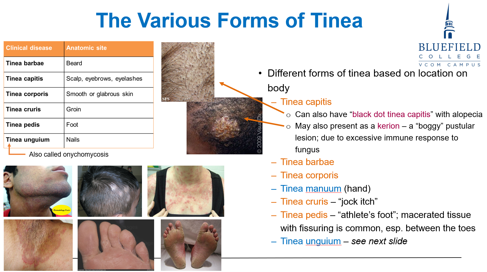 <p>C. Black dot type<br></p><p><strong>Black dot tinea capitis</strong> shows <strong>broken hair shafts</strong>, appearing as <strong>black dots</strong> on scalp.</p>