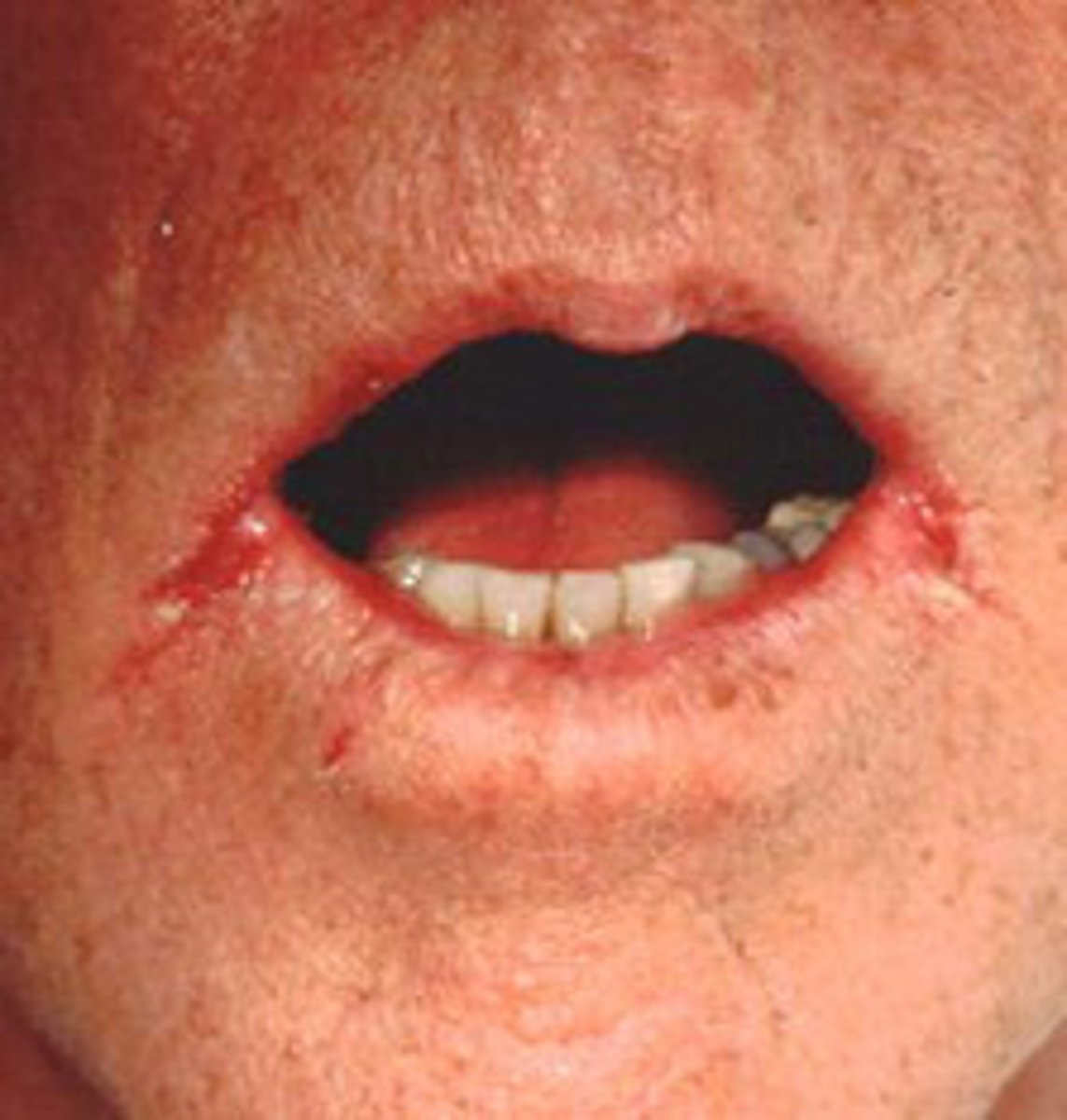 <p>erythema, fissuring, scaling at commissures</p><p>• candidiasis</p><p>• vertical dimension</p><p>• Vitamin B12 deficiency</p>