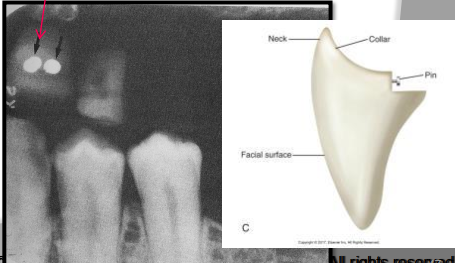 <p>Metal retention pins found on the anterior porcelain denture teeth </p><ul><li><p>tiny dense radiopacities superimposed over the denture teeth. </p></li></ul><p></p>