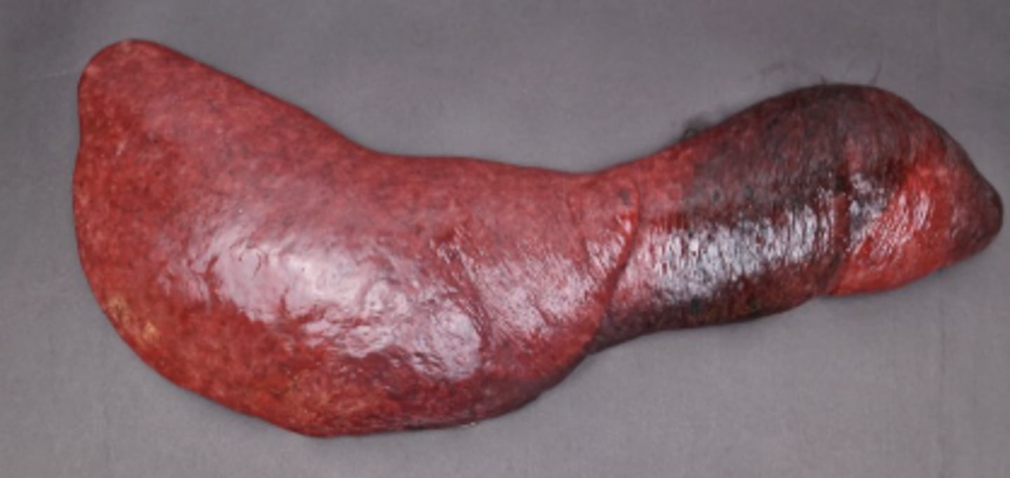 <p>Describe this lesion + diagnosis</p>