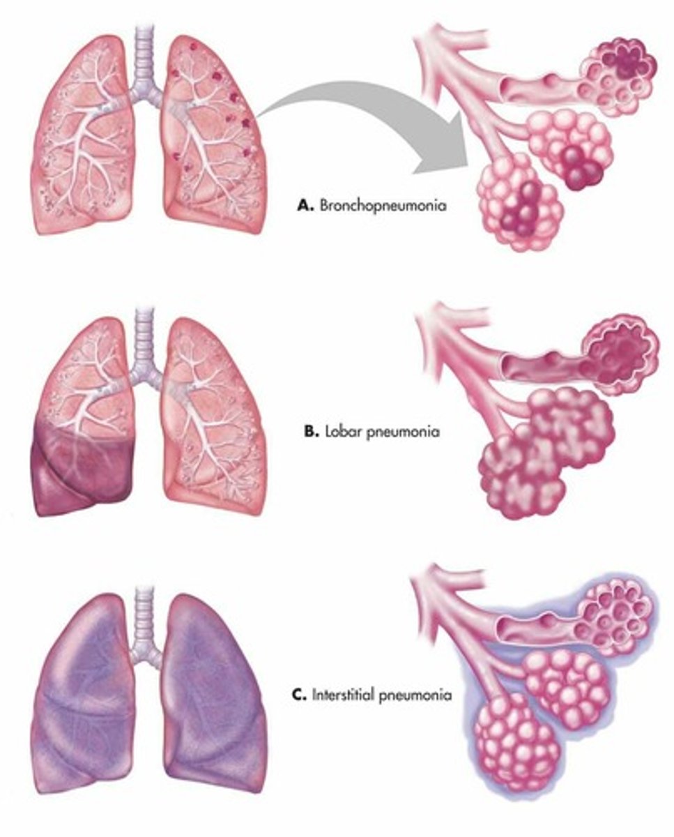 <p>•Community-acquired pneumonia (CAP)</p><p>•Hospital-acquired pneumonia (HAP)</p><p>•Ventilator-associated pneumonia (VAP)</p><p>OR</p><p>bronchiole pneumonia (lobular)</p><p>atypical / interstitial pneumonia</p><p>lobar pneumonia (affects lung parenchyma, mainly alveoli)</p>