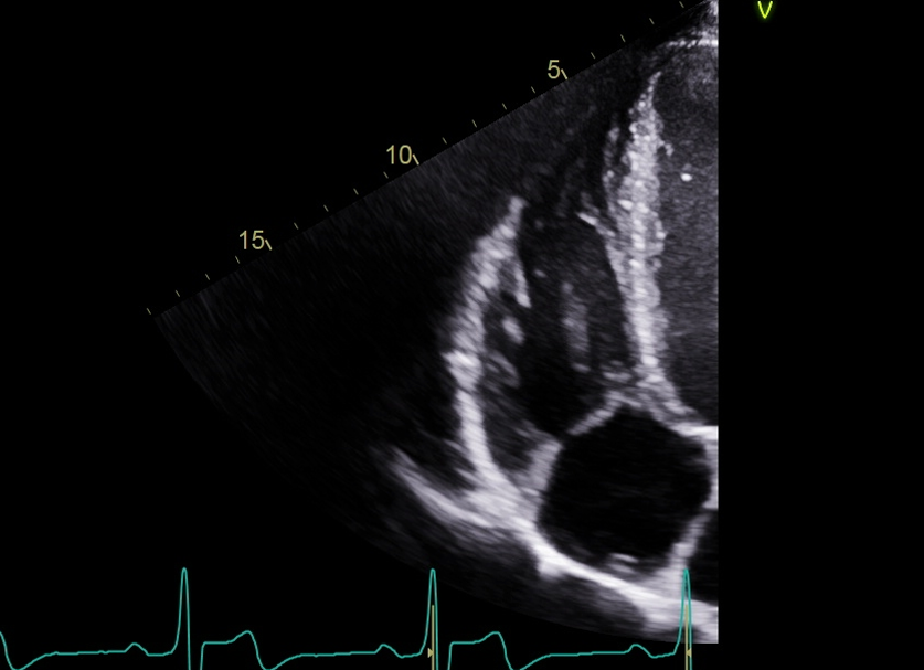 <p>Obtain an on axis images for the right heart</p>