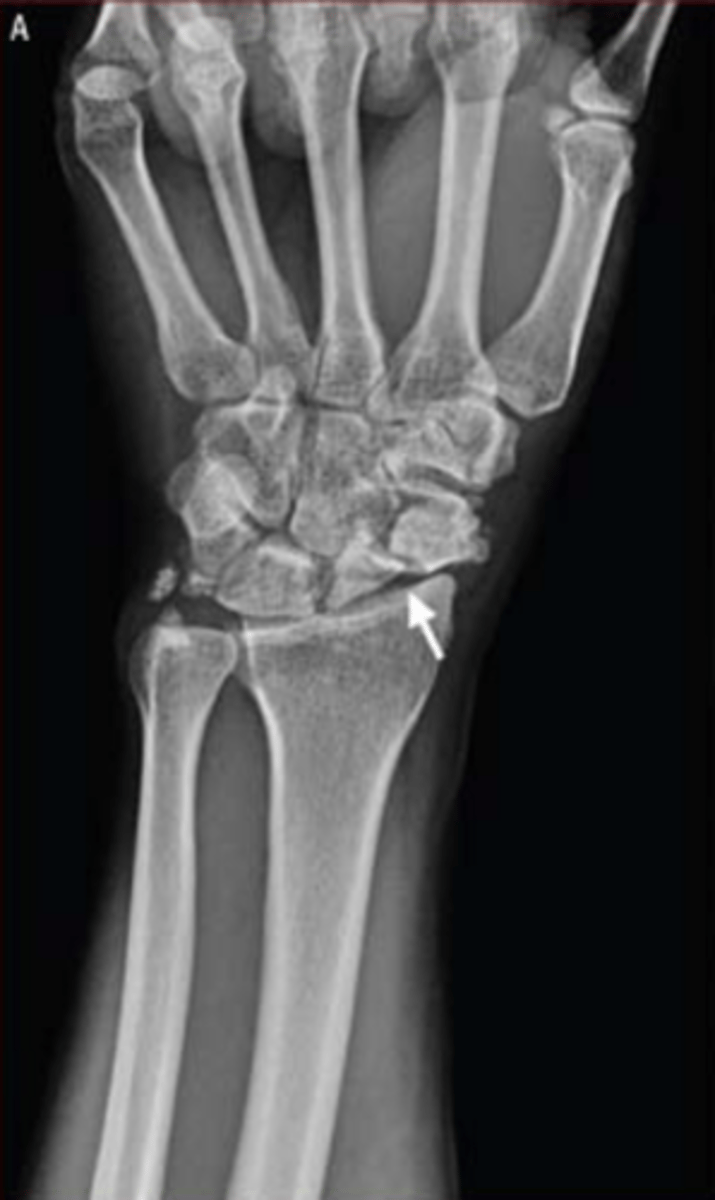 <p>non-union scaphoid fracture</p><p>3 multiple choice options</p>