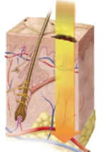 <p>Third-degree burn (full-thickness burn)</p>