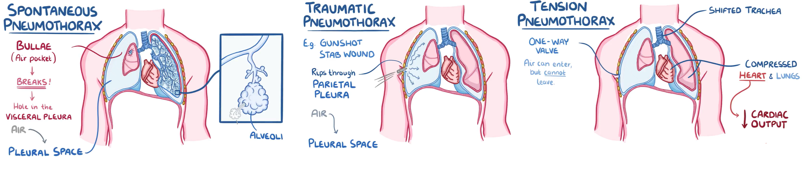 <p><span><span>Pneumothorax is broadly classified </span></span><span>with distinct mechanisms and clinical implications.</span></p>