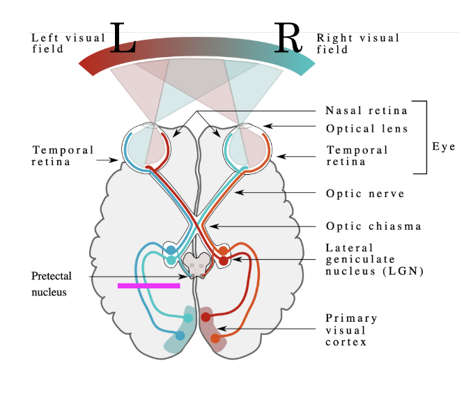 <p>What does the visual deficit (lesion) at the left optic tract/radiations (CNS) cause?</p>