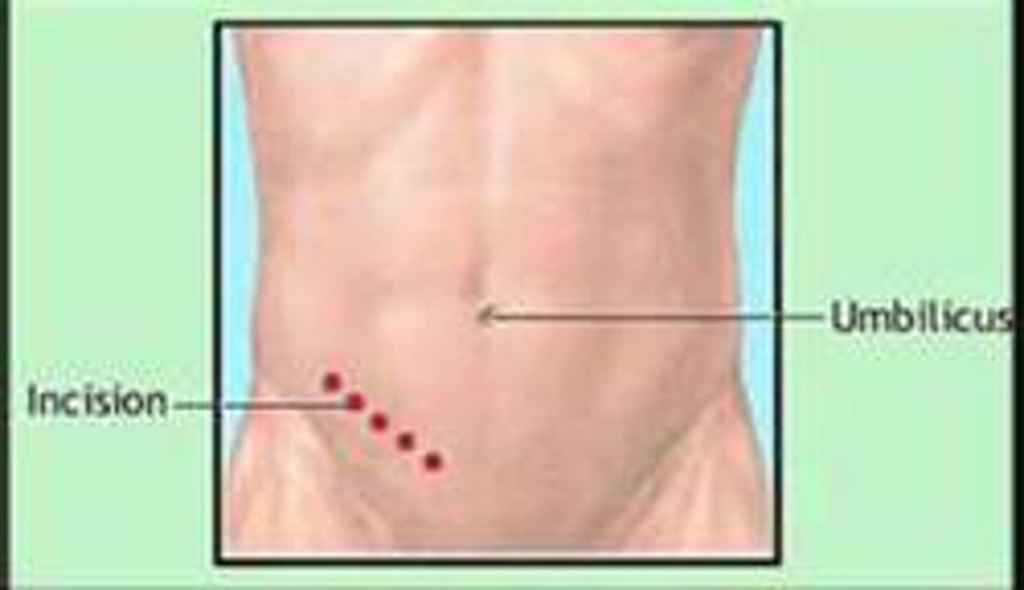 <p>small, oblique, RLQ incision for an appendectomy through McBurney's Point</p><p>⅓ from the anterior superior iliac spine to the umbilicus</p>